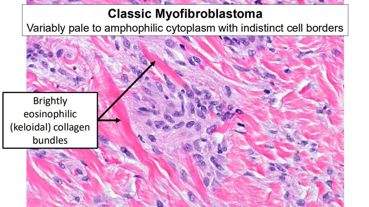 Janiranavarro's tweet photo. "Common" bland spindle cell lesions of breast
Myofibroblastoma

- Benign neoplasm of breast stromal myofibroblasts
- Typically treated with excision and are not known to recur
- Share  genetic alterations with spindle cell lipomas
- IHC: Positive for CD34, ER, SMA and desmin

Dr. Cimino-Mathews #USCAP #pathology #PathX #pathtwitter #breastpath