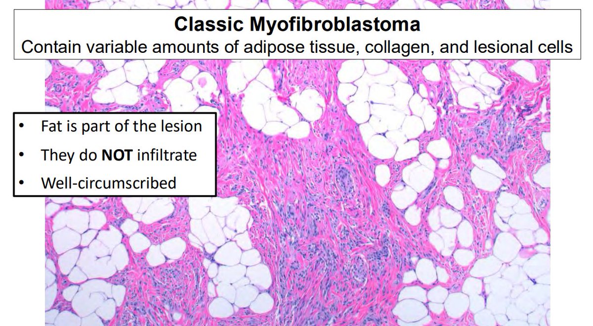 Janiranavarro's tweet photo. "Common" bland spindle cell lesions of breast
Myofibroblastoma

- Benign neoplasm of breast stromal myofibroblasts
- Typically treated with excision and are not known to recur
- Share  genetic alterations with spindle cell lipomas
- IHC: Positive for CD34, ER, SMA and desmin

Dr. Cimino-Mathews #USCAP #pathology #PathX #pathtwitter #breastpath