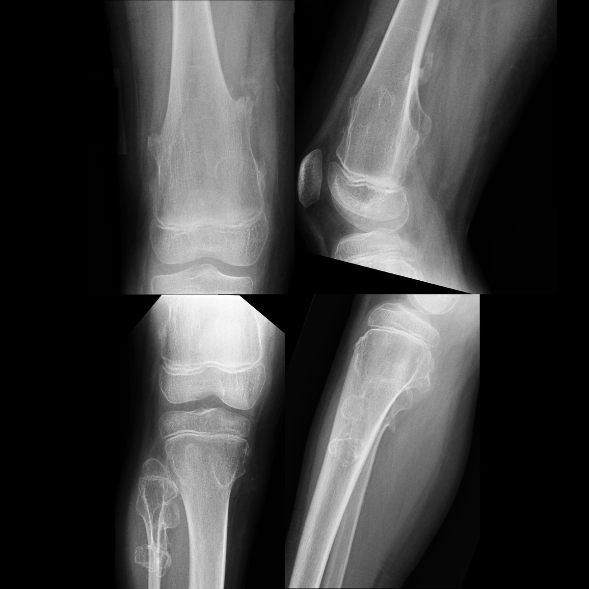 pedsimaging's tweet photo. School ager with leg pain after a fall
AP (left)+lateral (right) radiographs of leg show multiple lesions arising from distal femoral+proximal tibial metaphyses.
#FOAMed #FOAMRad #PedsRad #RadEd #radiology #pediatrics #radiologia #Ortho #Orthopedics #Orthopaedics #OrthoTwitter https://t.co/47NbocxiSR