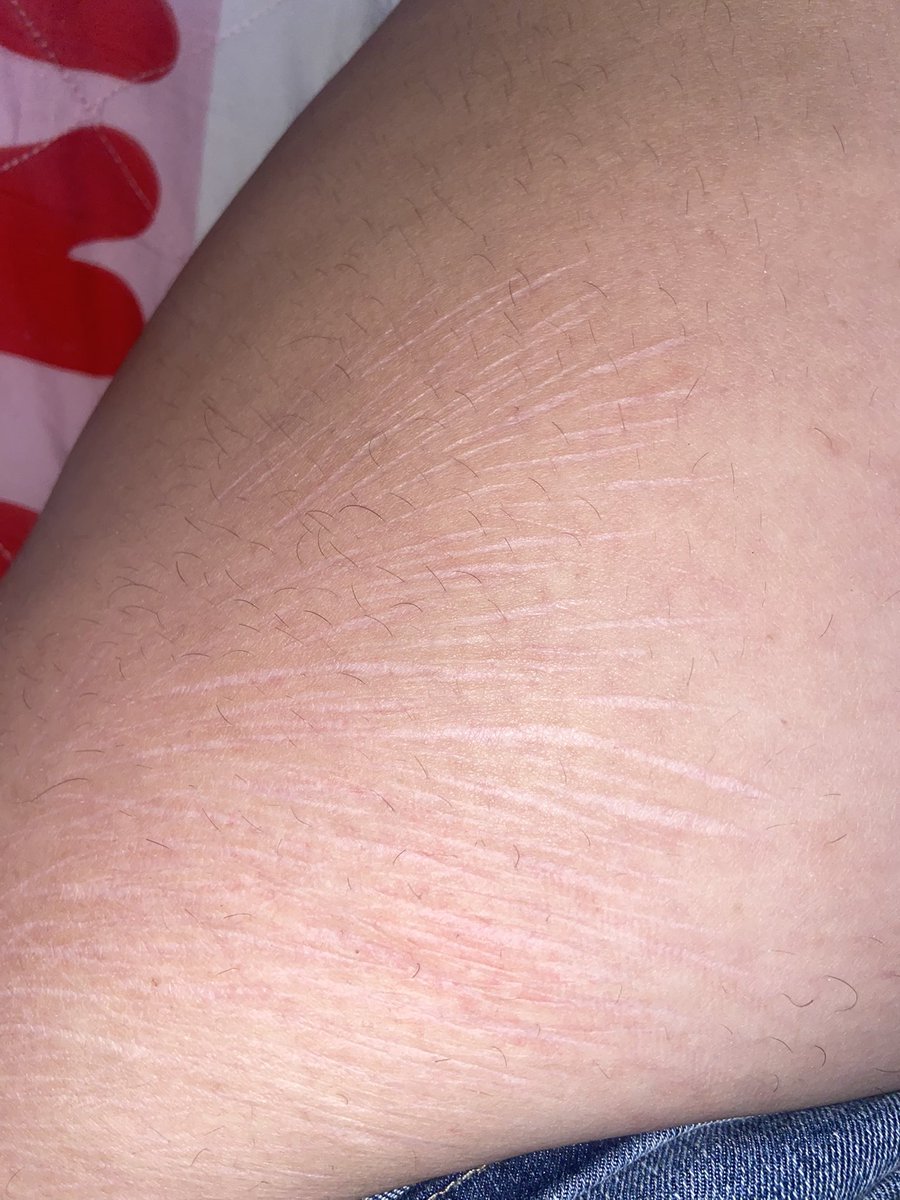 Sageeeeee00's tweet photo. Old ass scars I miss styros sm 
#scarinspo https://t.co/wRG0RObDiY