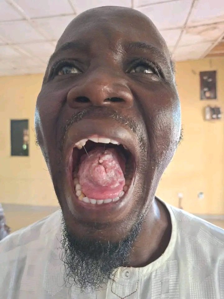 MujahidSSaad's tweet photo. Inna lillahi wa inna ilayhi raji’un

Kungiyar Patients and Destitute Welfare Organization (PADWO)

Mal. Abdullahi Muhammad
Hospital Number: 914333.

Wannan Bawan Allah Malam Abdullahi Muhammed Na cikin wani Rashin lafiya Mai tayar da hankali wanda Malam Abdullahi bashi iya cin abinci akan wannan matsalar da ke cikin bakin sa Yazo Ofishin Mu na PADWO dake Tsohuwar local government Argungu, Inda ya nimi a daura hoton sa domin a taimaka masa Da kudin da za'a yi masa aiki a Asibitin Koyarwa ta Tarayya ta Sokoto UDUTH... 

Al'ummar Musulmi Wannan Bawan Allah na cikin Wani tashin hankali Mai tayar da Hankali domin Abdullahi Bashi iya cin abinci don Girman zatin Ubangiji Allah Al'umma ku taimaki Wannan bawan Allah ayi masa aiki Fisabilillah.. 

-Radiotherapy (EBRT): ₦1,020,000.00 
-Chemotherapy (₦80,000 × 6 sessions): ₦480,000.00
-Investigations: ₦200,000.00
- Miscellaneous Expenses: ₦300,000.00

Total Cost of Treatment: ₦2,000,000.00

Inda kudin aikin sun kama Nera Miliyan Biyu Yima Allah sai ana daure Wallahi Don Allah a taimaka Fisabilillah.. 

Account Name: PADWO
- Account Number: 1019438130
- Bank: United Bank for Africa (UBA). 

Muna Addu'a Ubangiji Allah Subhanahu wata'ala Ya Bada ikon taimakawa Allah ya bashi lafiya yasa kaffara ne kuma Allah ya bada ikon taimaka masa.... 

Patients and Destitute Welfare Organization PADWO MEDIA TEAM JUN 30/7/2026.