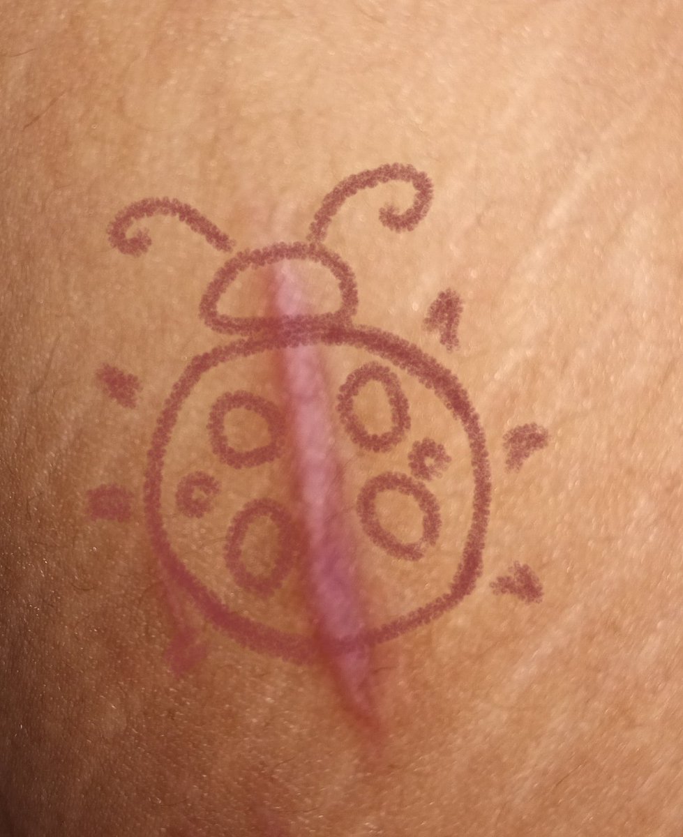 berryits3am's tweet photo. My bodies kinda gross,but the bugs seem to like it #shtwt I want to be a bug https://t.co/XnwrkuU7Ch