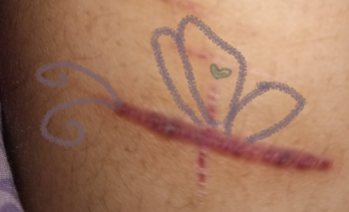 berryits3am's tweet photo. My bodies kinda gross,but the bugs seem to like it #shtwt I want to be a bug https://t.co/XnwrkuU7Ch