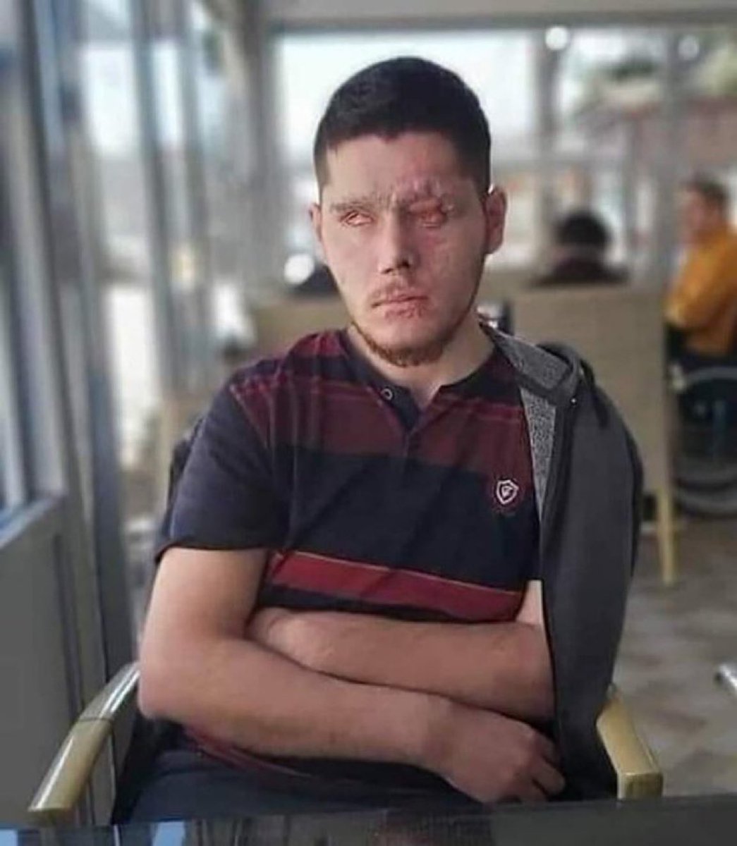 TurkcuPaylasim's tweet photo. Çukurca'da görev yaparken teröristlerin tuzakladığı EYP'nin patlaması sonucu gözlerini kaybeden Gazimiz, Mücahit Atıcı. https://t.co/C5PDppUhM6