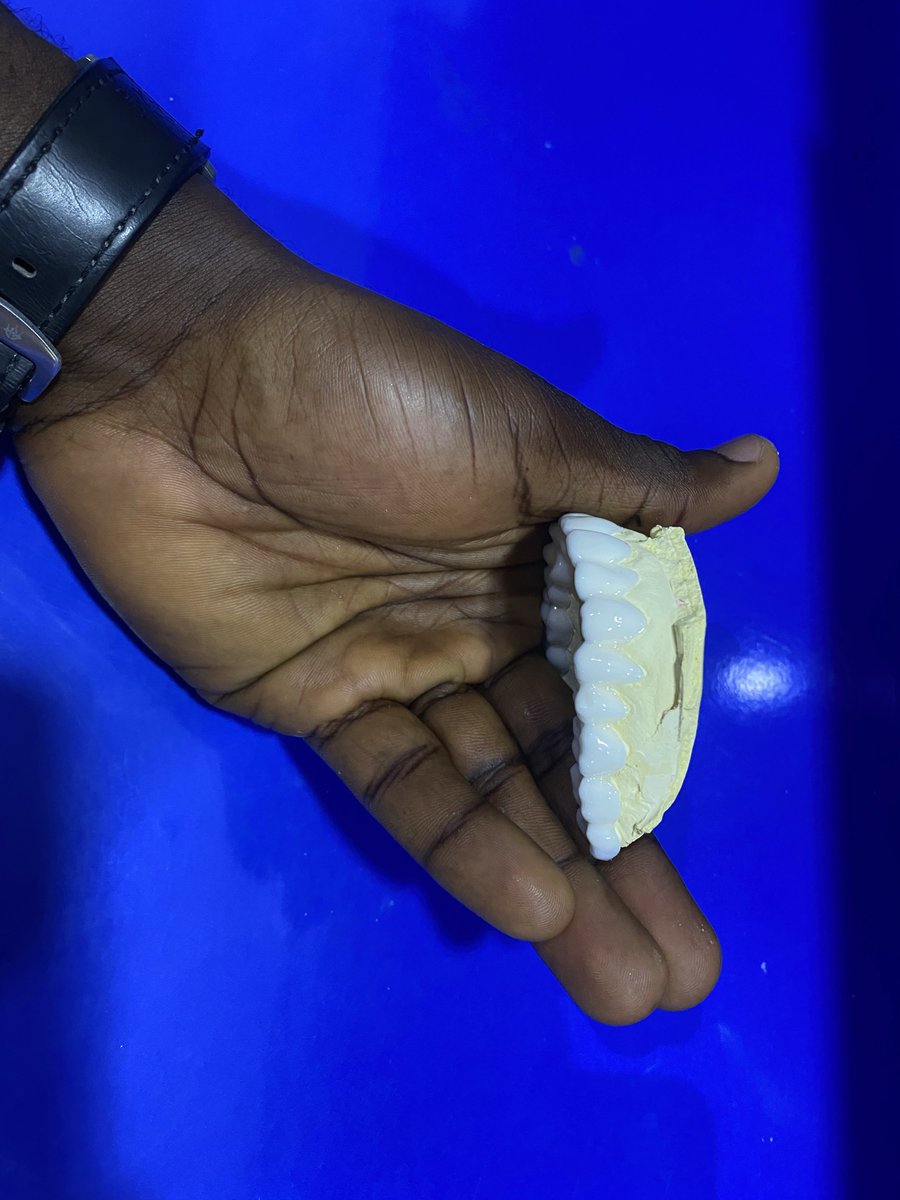 45moreshow's tweet photo. Snap-on veneer
No need for tooth preparation and it is removable 
Just snap it on and u have a white tooth 🦷 https://t.co/BE3yxEjli8