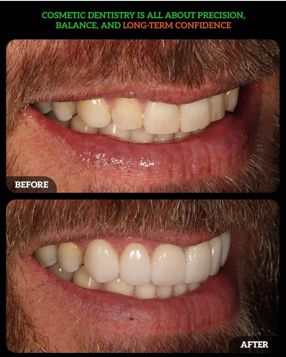 DMDGroup's tweet photo. ✨ What We Enhanced:
• Smile symmetry and proportions
• Tooth shape and contour
• Overall brightness and uniformity
• Natural, polished aesthetic

📍 Dublin Metro Dental – Dublin, Ohio
📞 (614) MY-SMILE
🌐 https://t.co/cTIepI3ioF https://t.co/bKI8A2JDYM