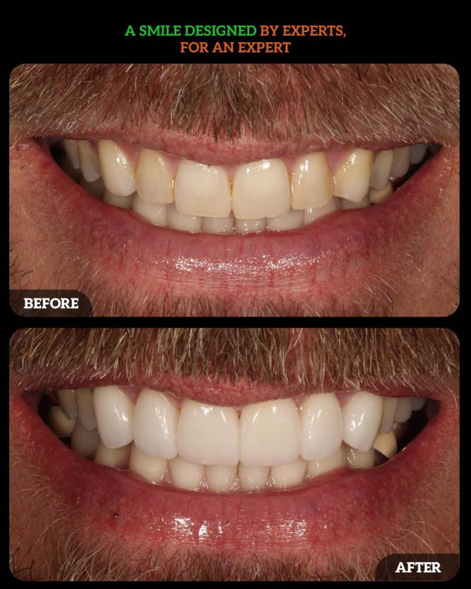 DMDGroup's tweet photo. ✨ What We Enhanced:
• Smile symmetry and proportions
• Tooth shape and contour
• Overall brightness and uniformity
• Natural, polished aesthetic

📍 Dublin Metro Dental – Dublin, Ohio
📞 (614) MY-SMILE
🌐 https://t.co/cTIepI3ioF https://t.co/bKI8A2JDYM