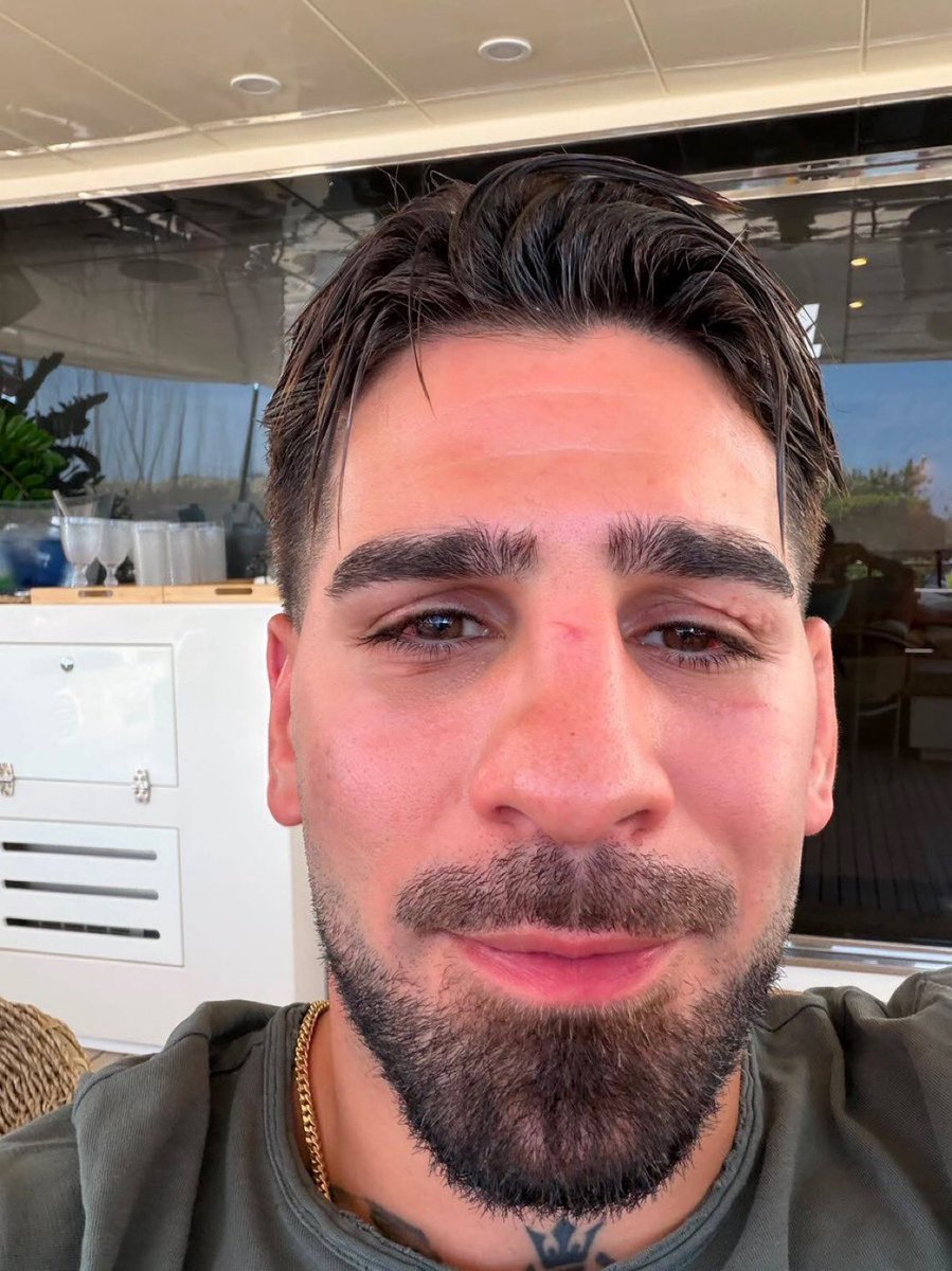acdmma_'s tweet photo. 🚨 new Ilia Topuria face pic

i feel like the damage Justin Gaethje did to him is going to affect him in his fights for the rest of his career https://t.co/itlkJ4gWur