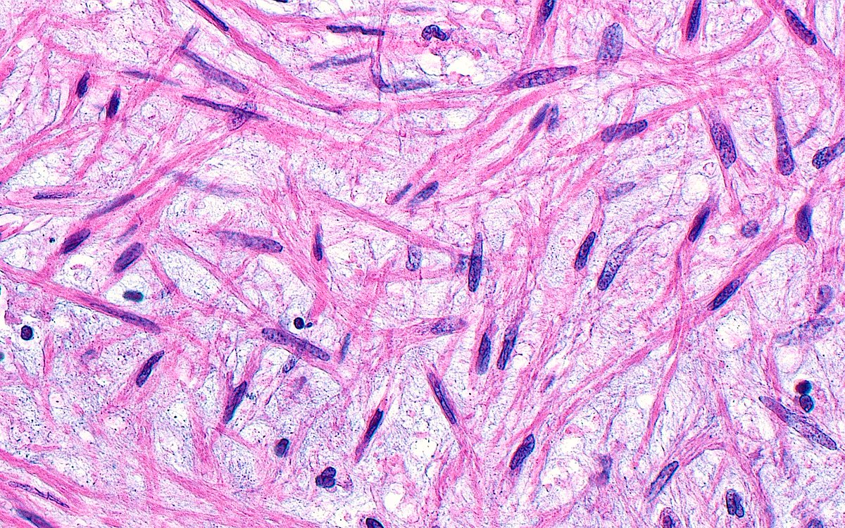 ziad_zaatari's tweet photo. π¬πΈ "Thin Spindle Wisps and Fibers" ~ Fibroblasts from the intimal layer of a pulmonary artery ~ #Pathology #Histology #PathArt π¨ #BioArt #Sciart #Microscopy https://t.co/q3Kt5YXlPE