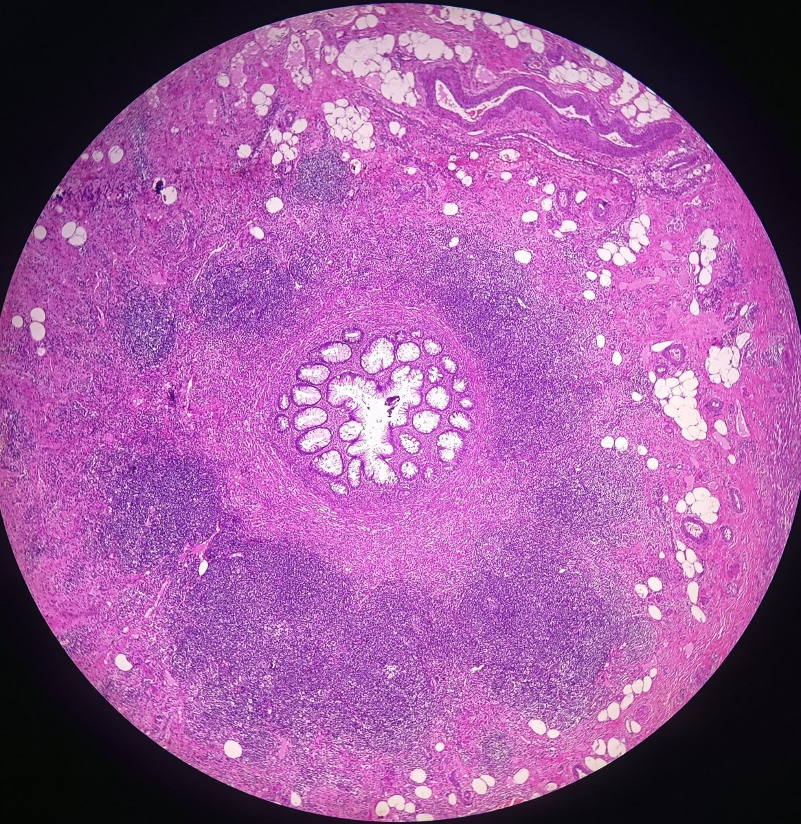 JessicaVineyard's tweet photo. Is this appendix epithelium normal, or could it be suggestive of LAMN?

Female, 64 yo, acute appendicitis https://t.co/fAeMgmeMZA