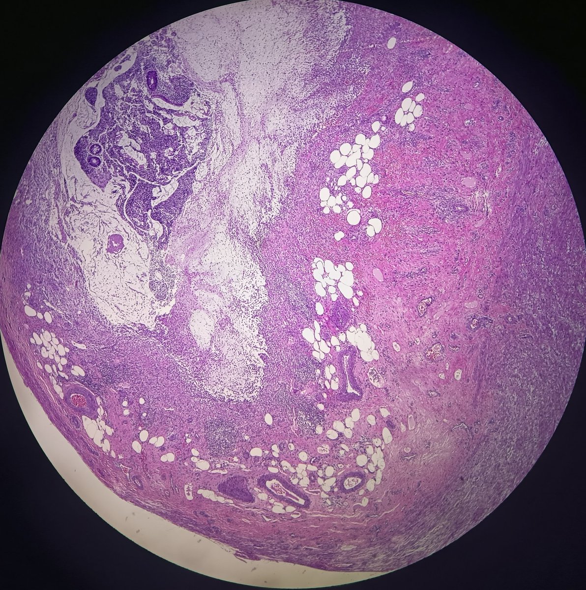 JessicaVineyard's tweet photo. Is this appendix epithelium normal, or could it be suggestive of LAMN?

Female, 64 yo, acute appendicitis https://t.co/fAeMgmeMZA