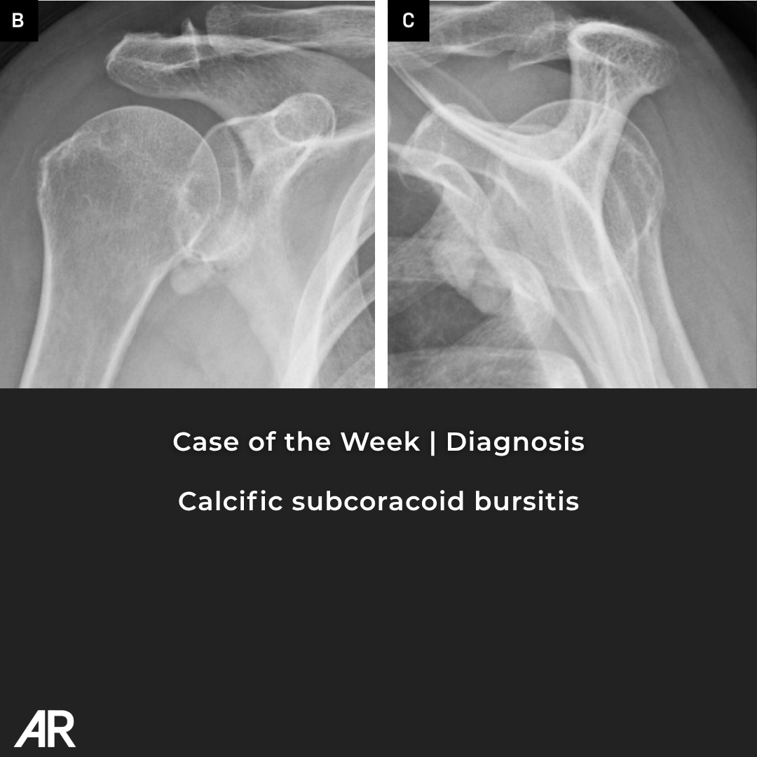 Applied_Rad's tweet photo. π©» Case Study of the Week - Diagnosis time!
Calcific Subcoracoid Bursitis
π See all the case details, more images, and diagnosis: https://t.co/Qo6vVaIC31
#Radiology #RadEd #MedEd #RadiologyEducation #COW #CaseOfTheWeek https://t.co/8hjBffYgJC