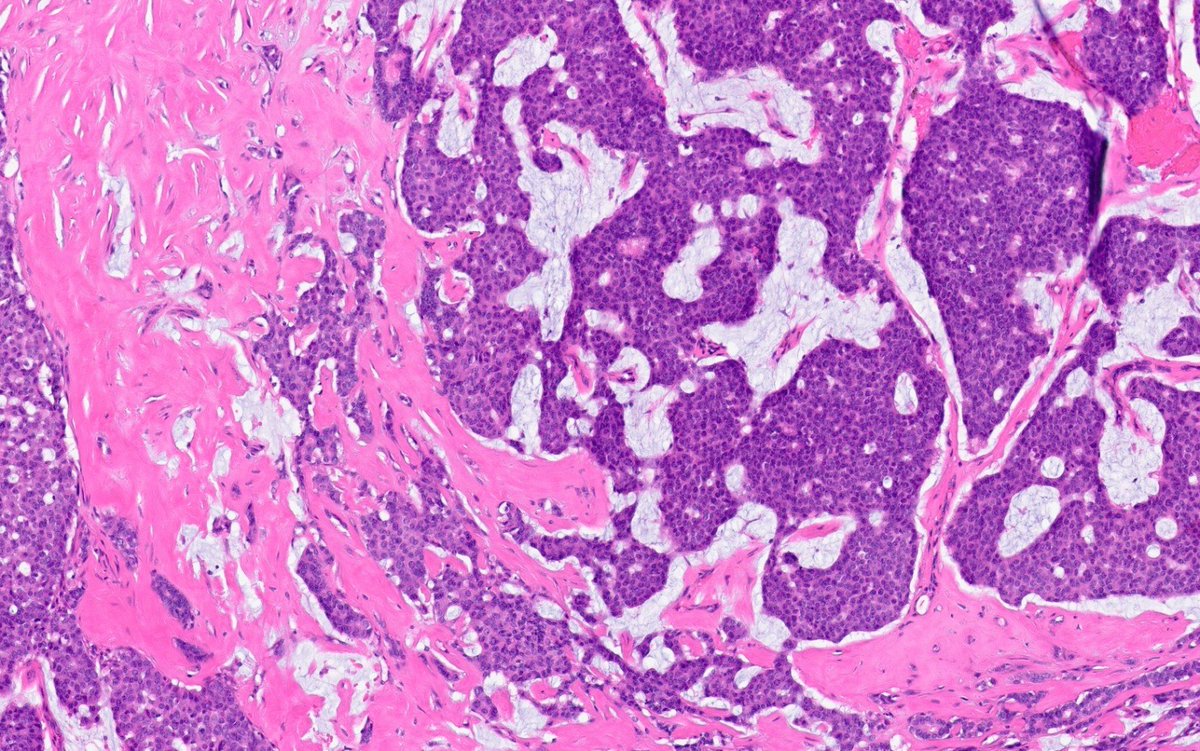 fouad_boulos's tweet photo. Happy Friday, everyone. Here's a cool case to think about over the weekend (yeah right😀)

Central duct excision for bloody nipple discharge. No previous biopsy. 

What is your diagnosis?

#breastpath https://t.co/lfxgfoG9WI