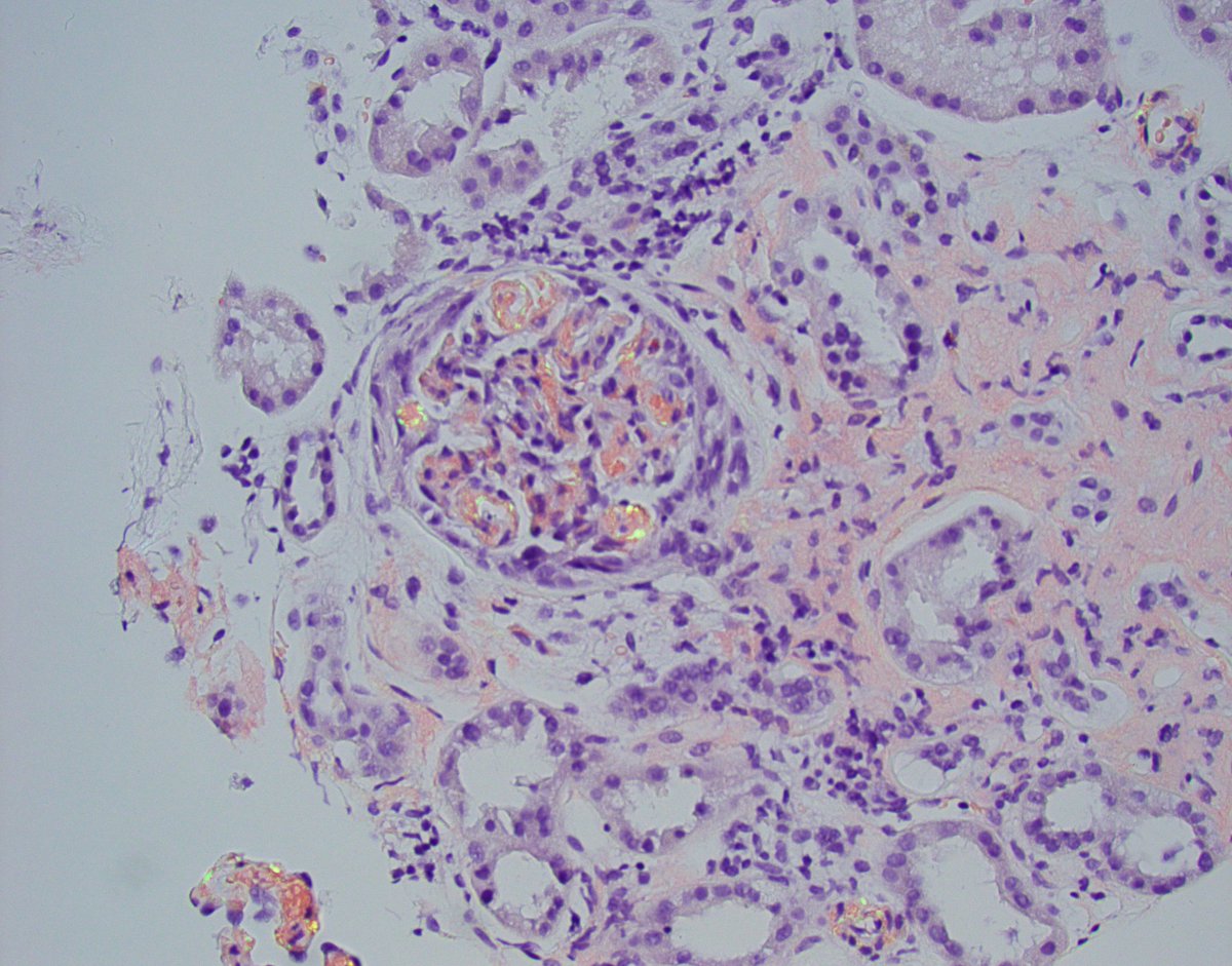 JZRenalPath's tweet photo. Another interesting case with crescents but this time due to amyloid. A few small cellular crescents in this case of AL-amyloidosis. Massive capillary wall amyloid infiltration. #renalpath #pathtwitter #nephrology https://t.co/nscK63DZwK