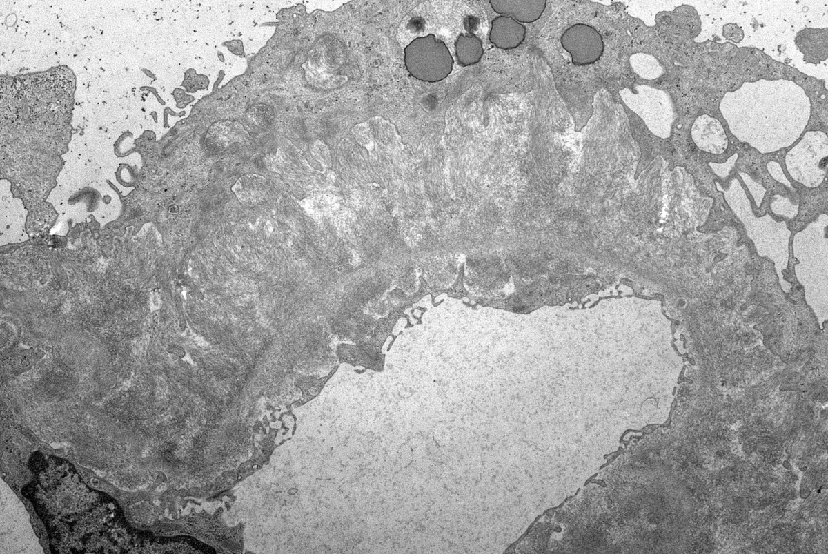 JZRenalPath's tweet photo. Another interesting case with crescents but this time due to amyloid. A few small cellular crescents in this case of AL-amyloidosis. Massive capillary wall amyloid infiltration. #renalpath #pathtwitter #nephrology https://t.co/nscK63DZwK