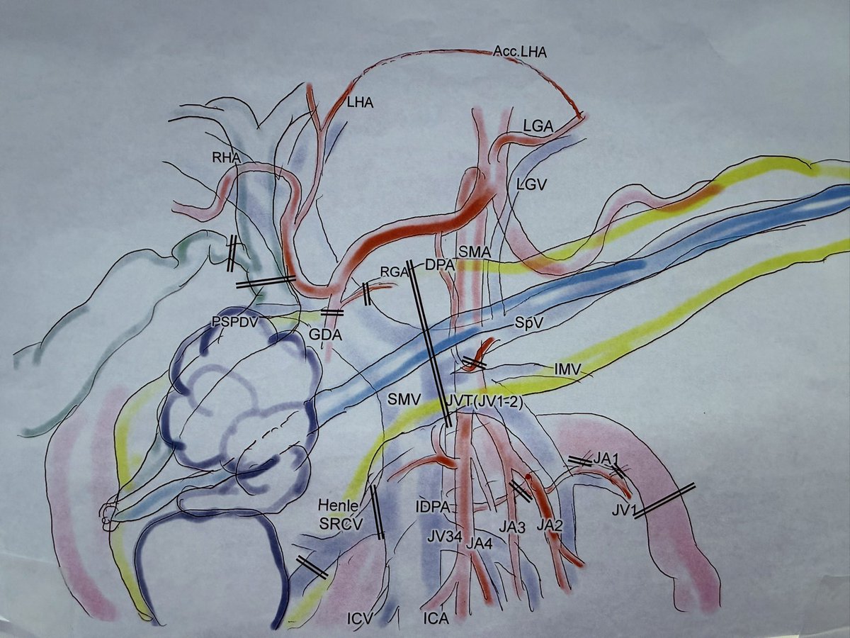 Gio_Marchegiani's tweet photo. Masterclass training for 🤖 PD from @YosukeInoueHPB 🇯🇵 at Teikyo University 

👈 Left approach to SMA after meticulous preop surgical planning with drawing ✍️ 

The rest.. is just Japanese hospitality at its best 🎎 so honored !!! https://t.co/LbanjUb4mD