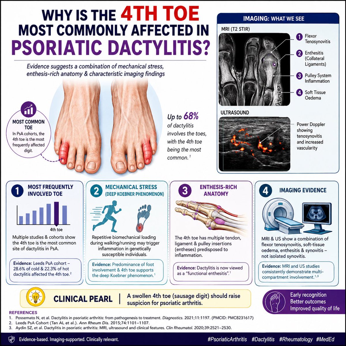 dr_immuno29's tweet photo. Why is the 4th toe the most commonly affected digit in psoriatic dactylitis? 

The exact reason remains unclear, but current evidence points towards a combination of:

• Repetitive biomechanical stress (“deep Koebner phenomenon”)
• Enthesis-rich anatomy of the 4th toe
• Flexor tenosynovitis as the dominant lesion
• Diffuse soft tissue inflammation, rather than isolated synovitis

📌 The 4th toe is consistently reported as the most frequently involved toe in psoriatic arthritis cohorts.

Clinical Pearl:
A painful, swollen 4th toe (“sausage digit”) should always prompt evaluation for psoriatic arthritis, even in the absence of obvious skin psoriasis.

Key References
• Possemato N, et al. Diagnostics. 2021;11:1197. PMCID: PMC8231617
• Tan AL, et al. Ann Rheum Dis. 2015.
• McGonagle D, et al. Functional enthesitis concept in psoriatic disease.

#PsoriaticArthritis #Dactylitis #Rheumatology #MedTwitter #FOAMed #MSK #Ultrasound #MRI #Immunology #EvidenceBasedMedicine
