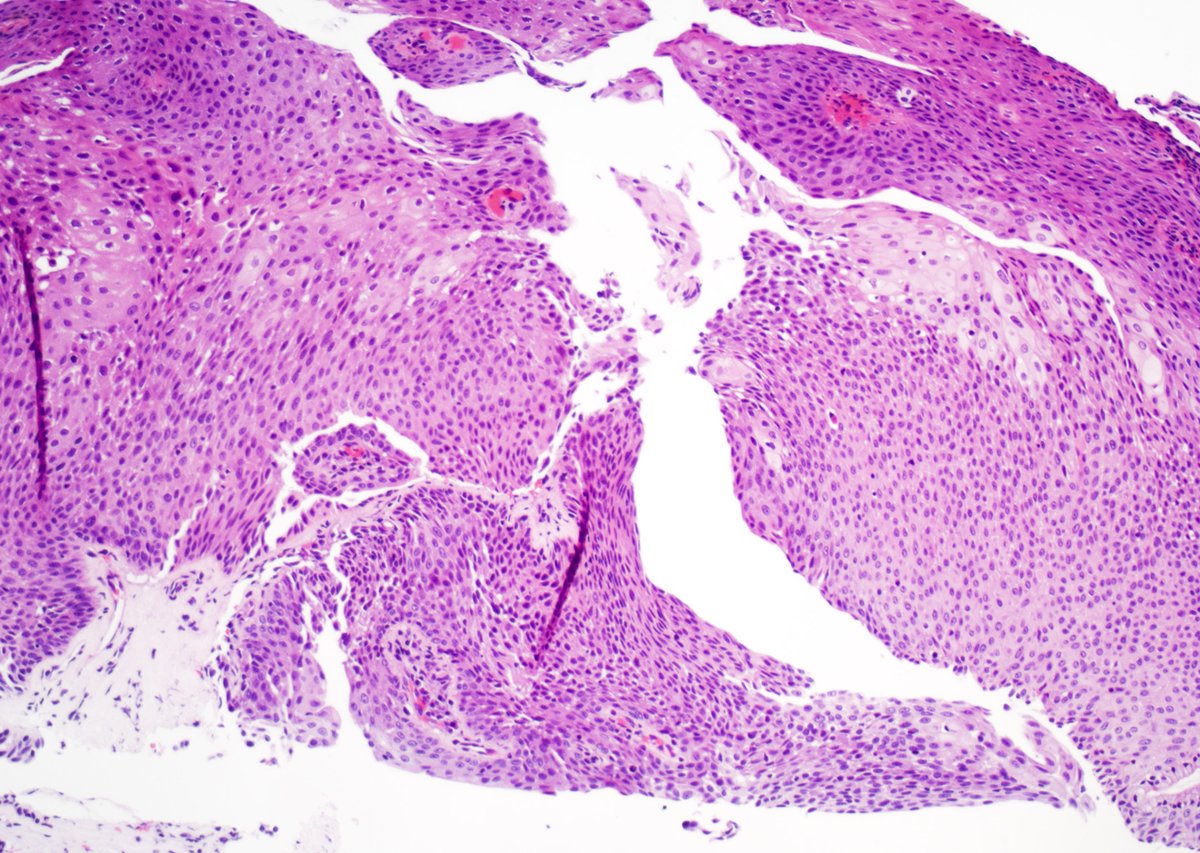 GuannanTiffany's tweet photo. 🧩 Urethral riddle

67-year-old man with a small urethral mass.

I confess, there is a trap. 😊

What is your diagnosis? What do you want to order?

#DxMindMap #UrethralPath #GUPath #PathTwitter @JHUpath https://t.co/r3MBgAXsGc