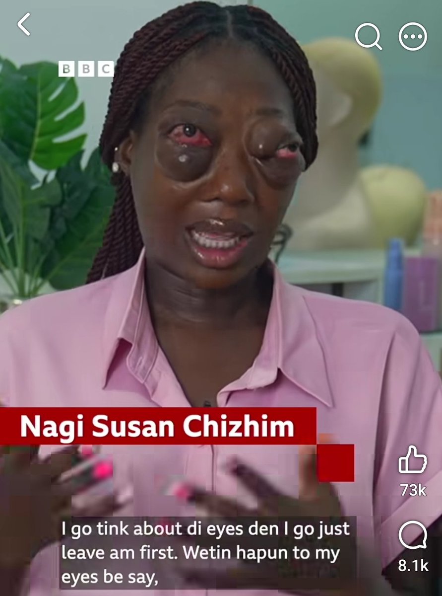 BigEarsLBC's tweet photo. Nigerians coming to the UK with weird ass shit going on.

Tuberculosis, Meningitis, Ebola and now bulging eyes??? https://t.co/zhSCih9XgW