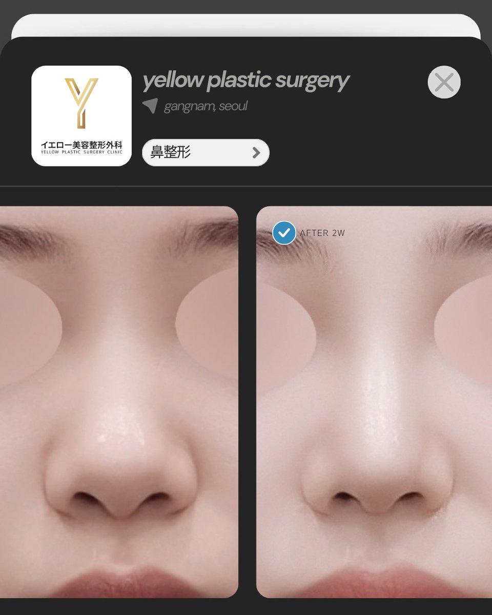 yellowpsjp's tweet photo. イエロー症例💛

・手術内容
鼻フル
鼻筋：プロテーゼ
鼻先：鼻尖形成(鼻中隔軟骨、耳介軟骨)、団子鼻矯正、鼻唇角矯正

✔日本語担当者常住
✔カンナム駅すぐ前
✔腫れケア制限無し

【韓国】イエロー美容整形外科
📍ソウル江南区江南大路406 GLASS TOWER 5F
📲お問い合わせ https://t.co/p4KIdNVfvV https://t.co/X5GozXThAq