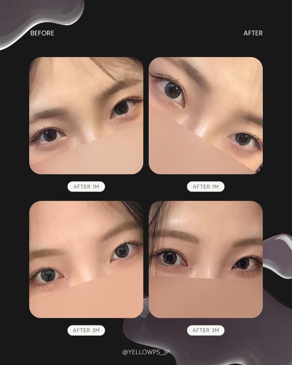 yellowpsjp's tweet photo. イエロー症例💛

ナチュ盛れデカ目整形✨

・手術内容
目尻切開＋タレ目形成(グラマラスライン)

韓国の美容整形アプリ
口コミ20,000件超え
満足度98％！
限定イベントも🎁

【韓国】イエロー美容整形外科
📍ソウル市江南区江南大路406, GLASS TOWER 5F
📲お問い合わせ：https://t.co/p4KIdNVfvV https://t.co/mR2ELvAwDM