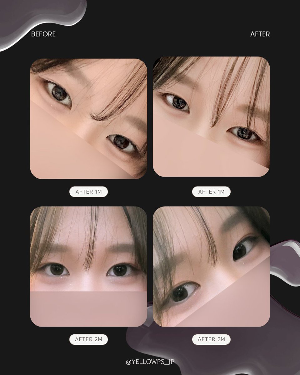 yellowpsjp's tweet photo. イエロー症例💛

バレずに垢抜けたい人必見👀

・手術内容
目尻切開＋タレ目形成(グラマラスライン)

韓国の美容整形アプリ
口コミ20,000件超え
満足度98％！
限定イベントも🎁

【韓国】イエロー美容整形外科
📍ソウル市江南区江南大路406, GLASS TOWER 5F
📲お問い合わせ：https://t.co/p4KIdNVNlt https://t.co/c6Egxa1Wds