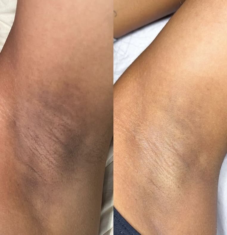 Justwandyy's tweet photo. If you have trouble with dark spots on your armpits, thighs, and knuckles, this is the trick I used to clear mine. https://t.co/iGk2txWPpj