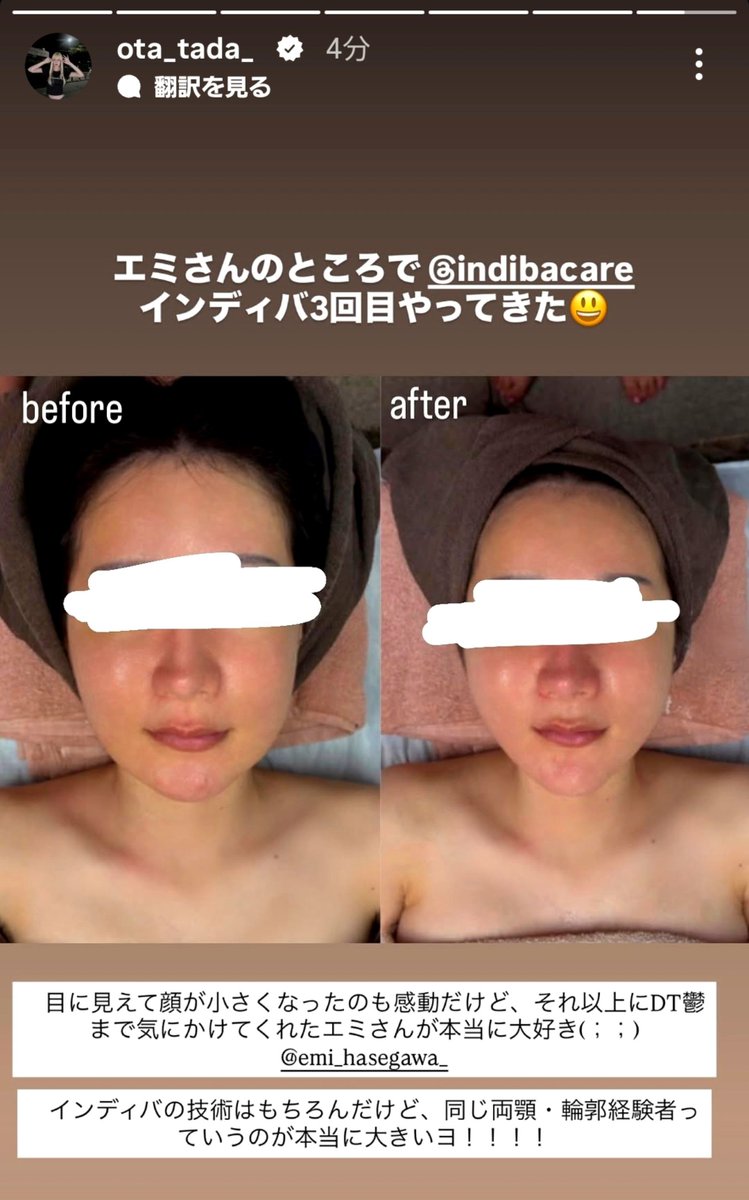 nyunnyun05's tweet photo. 両顎手術後の多田さんインディバビフォアフとおすすめのインディバクリニック🏥🍋

📍インディバケアプラチナム恵比寿

#整形垢と繋がりたい
#整形垢とつながりたい
#美容垢さんと繋がりたい
#整形垢さんと繋がりたい
#整形垢さんとつながりたい https://t.co/GfwixY6NmG