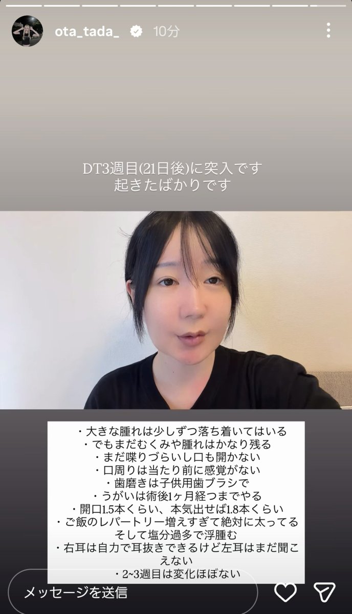 nyunnyun05's tweet photo. フェフ姉さんのお友達の多田さんが両顎手術後リアルなダウンタイムを公開してくれててめっちゃありがたい…
術後21日目で体感してるつらいことや改善したことなど具体的にレポしてくれててこれからやる人たちはすごい参考になると思う✍️

#美容垢さんと繋がりたい
#整形垢さんと繋がりたい https://t.co/OeGKRrKG8D