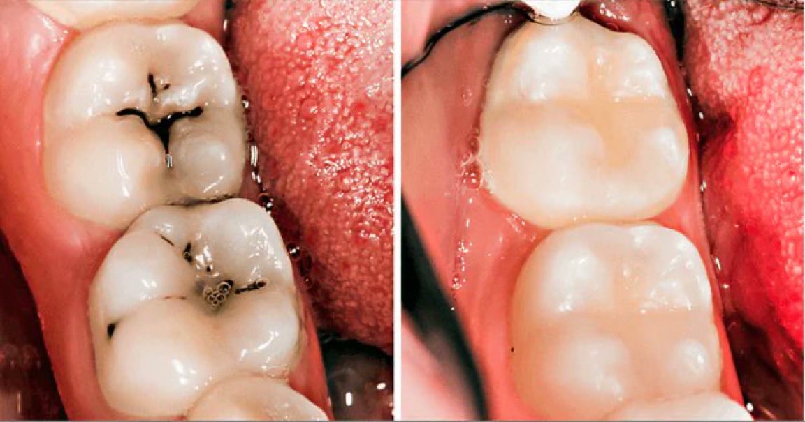 FarvingCo's tweet photo. What your dentist won’t tell you to prevent cavities, gum disease, and bad breath:

TWO bacteria are behind most of it. And your dentist never mentioned either one.

1. S. mutans. Builds biofilm on your teeth.

That film you feel when you wake up. Brushing removes the film. Doesn’t kill the bacterium.

2. P. gingivalis. Lives beneath your gumline. 

Your toothbrush can’t reach it. Recolonizes hours after flossing.

P. gingivalis was found in 90% of Alzheimer’s brains. PMID: 30746447

The bacterium in your gums is linked to the disease destroying your brain.

One compound kills both. Your dentist never mentioned it either.

Here’s what it is and exactly how to use it 👇