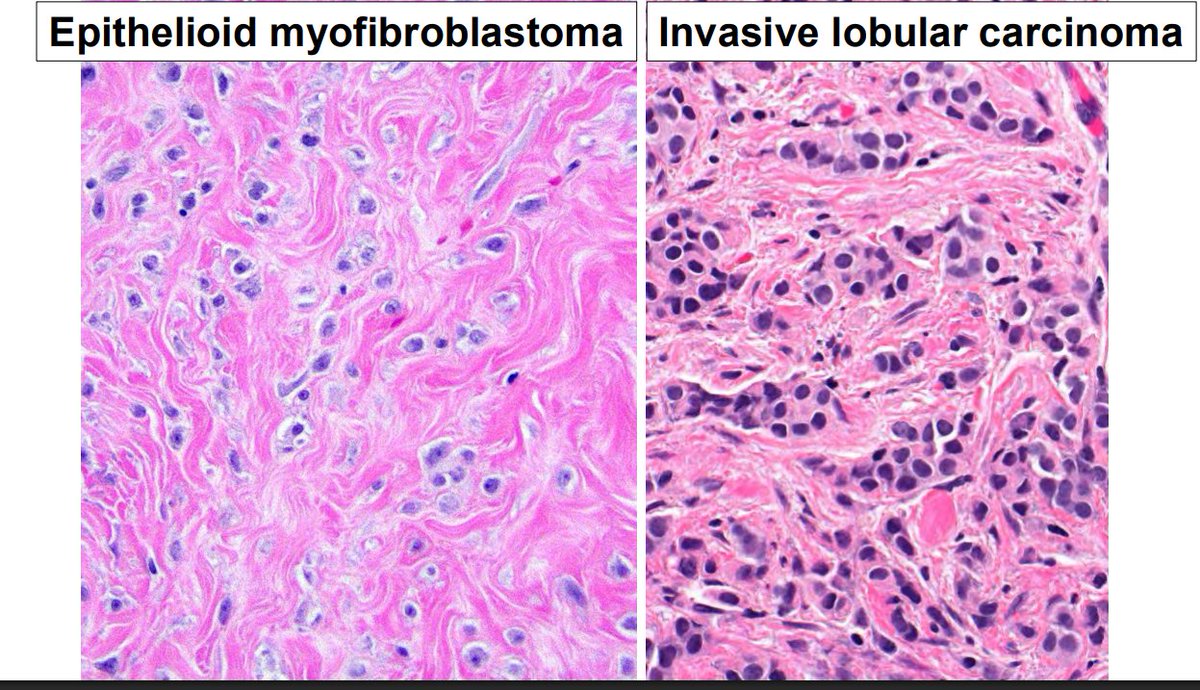 Janiranavarro's tweet photo. "Common" bland spindle cell lesions of breast
Myofibroblastoma

- There are multiple histologic patterns (pic 1)
- Epithelioid myofibroblastoma can be confused histologically with invasive lobular carcinoma.
- Both are ER positive. 
- Always run a keratin IHC

Slides from Dr. Cimino-Mathews #USCAP #pathology #PathX #pathtwitter #breastpath