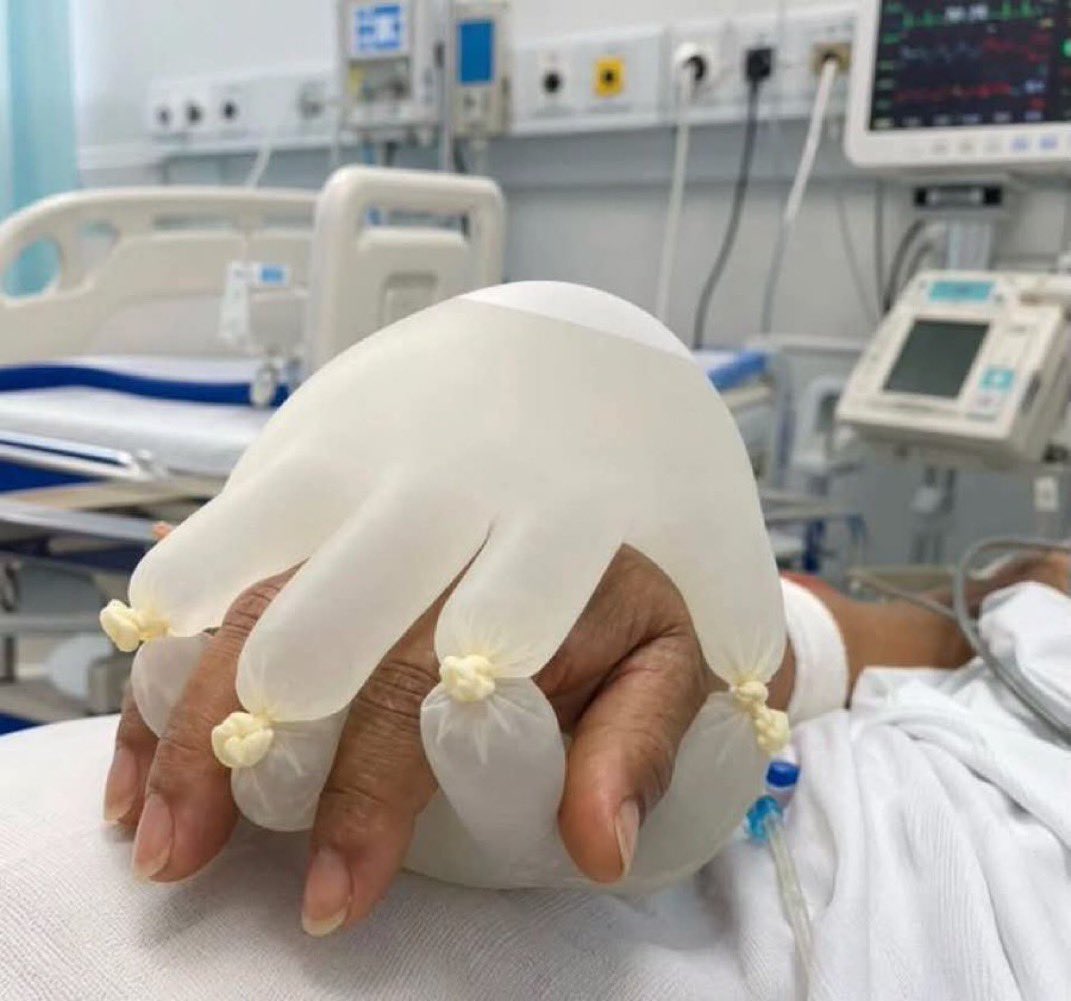 Paul_Wischmeyer's tweet photo. Why Would Healthcare Workers Do This In An
Unconscious Patient? https://t.co/2stgC0lggw