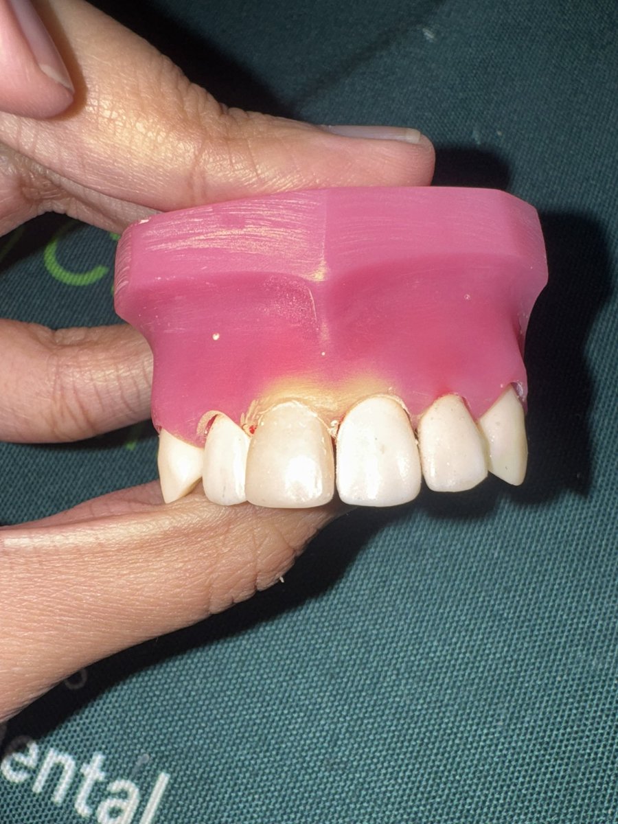 nabilnismara's tweet photo. anww lil quest today: main tambal timbil direct veneer🫠🫠🫠 klu ble jyujyur… estetik is not my passion 😭🙏 tpiii ttb sruu🤩 hasilnya yaudalaya ges harab maklum #stilllearning #longlifelearner -_______- https://t.co/JsCcl3X0o5