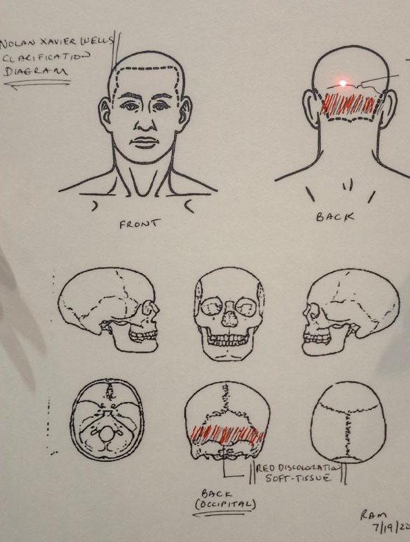 CoffindafferFBI's tweet photo. Nolan Wells

Everyone...

This is an autopsy head support. They are made of stainless steel.  

Nolan would have have his head resting on this for an extended period of time.  

The redness was described as redness, Not blunt force trauma. 

For some reason ($) people want to pull the race card and accuse Nolan's friends for his murder....

What murder you ask? 

The murder they created on social media. 

Waiting for one scintilla of evidence that Nolan was murdered. 

Even the family's autopsy showed 0 signs of foul play-

#NolanWells