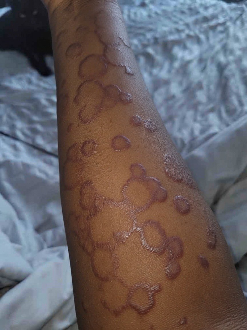 Empress_Brymex's tweet photo. Visited my boyfriend last weekend and I noticed this ring like pattern on my skin
Does anyone know the cause and how to clear it off? https://t.co/Px30yzzeSj