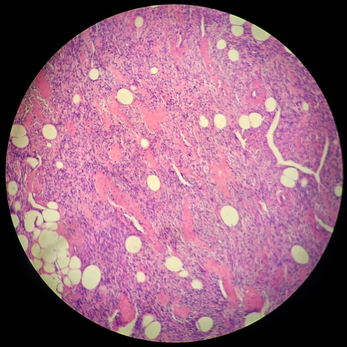 SyedSal55391459's tweet photo. #histopathology
#uterus
#pathX
#pathTwitter
#photomicrograph
Dx: Lipoleiomyoma. https://t.co/GmOPR7NfOe