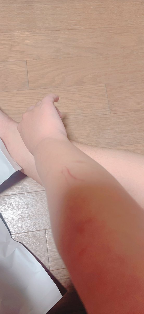 muui_nano's tweet photo. ちな前に投稿したのが左手で
右は腕を大福たちにやられまくって🐿🦟みたいになってる））） https://t.co/Yxyi5lj2IU