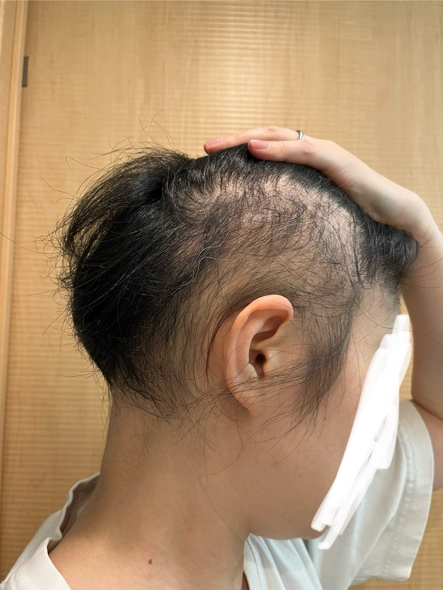 pollo_trk's tweet photo. 2回目235日目

予想以上に薄いというか、やはり2回植毛してもカバーしきれない。特に耳の後ろは過去の抜毛が効きすぎてて、髪長くなってもカバーできるのかな？ https://t.co/5DsQdmskIy