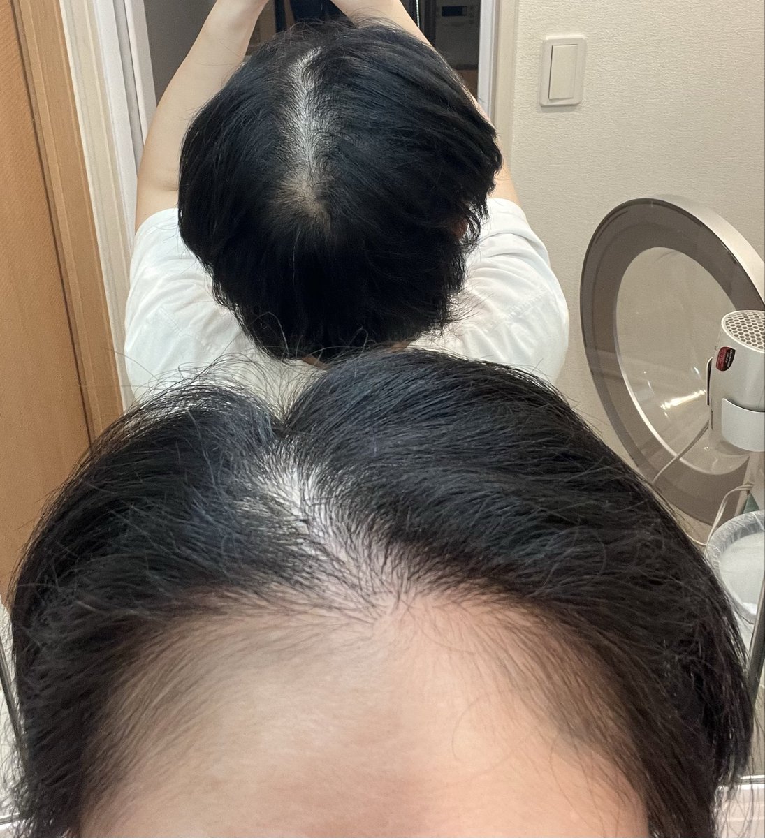 pollo_trk's tweet photo. あとはやっぱり前髪真ん中〜頭頂部は薄い。頭頂部は2回目は植えてないので、1回でこれくらいになるならもう一回やってみる価値はある気がしている。後ろ姿の透け具合が辛い😇 https://t.co/EQazAbktpD