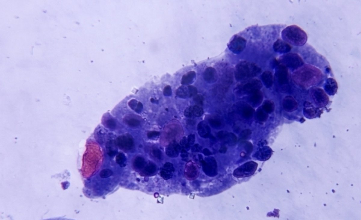 _94dr's tweet photo. tubular epithelial cells.     …

     #UrineMicroscopy #UrinarySediment https://t.co/lAhuUl1adY