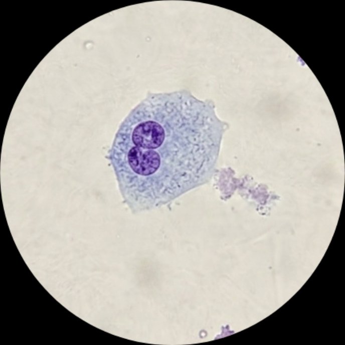 _94dr's tweet photo. Urothelial cell

#UrineMicroscopy #UrinarySediment https://t.co/R3ZsQ8h21q