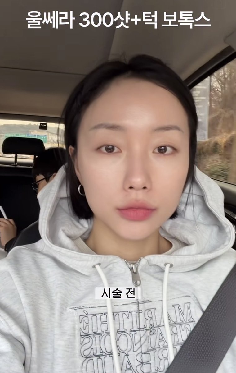 sonsudiggng's tweet photo. 20대,30초는 물론이고 얼굴살 없는 사람들!!!!울쎄라 금지🥲

이분 울쎄라 맞고 땅콩빔 맞은거 보고 나 댕충격받앗엇음...
의사가 자신있게 추천해서 한건데 이렇게됨....

이거 바로 돌이킬수도 없음. 반년-1년 이상태로 살아야됨ㅠㅠㅠㅠㅠㅠㅠㅠㅠ
 
울쎄라는 얼굴살 많은 사람도 신중하게 선택하기를!

출처 : 인스타그램(ofjeonga)