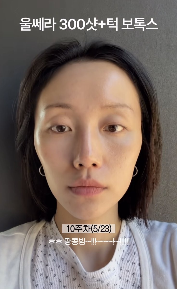 sonsudiggng's tweet photo. 20대,30초는 물론이고 얼굴살 없는 사람들!!!!울쎄라 금지🥲

이분 울쎄라 맞고 땅콩빔 맞은거 보고 나 댕충격받앗엇음...
의사가 자신있게 추천해서 한건데 이렇게됨....

이거 바로 돌이킬수도 없음. 반년-1년 이상태로 살아야됨ㅠㅠㅠㅠㅠㅠㅠㅠㅠ
 
울쎄라는 얼굴살 많은 사람도 신중하게 선택하기를!

출처 : 인스타그램(ofjeonga)