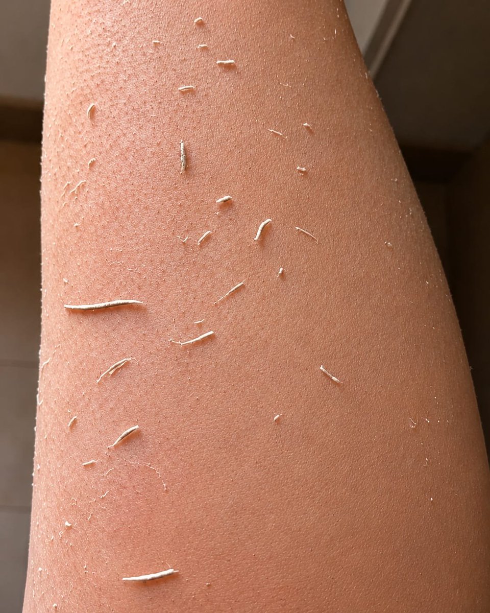 Thrigananadoota's tweet photo. Hey @grok, after I shower, these tiny particles come off when I rub my skin. What are they and should I be concerned? 😳 https://t.co/4rLbF6jFMO