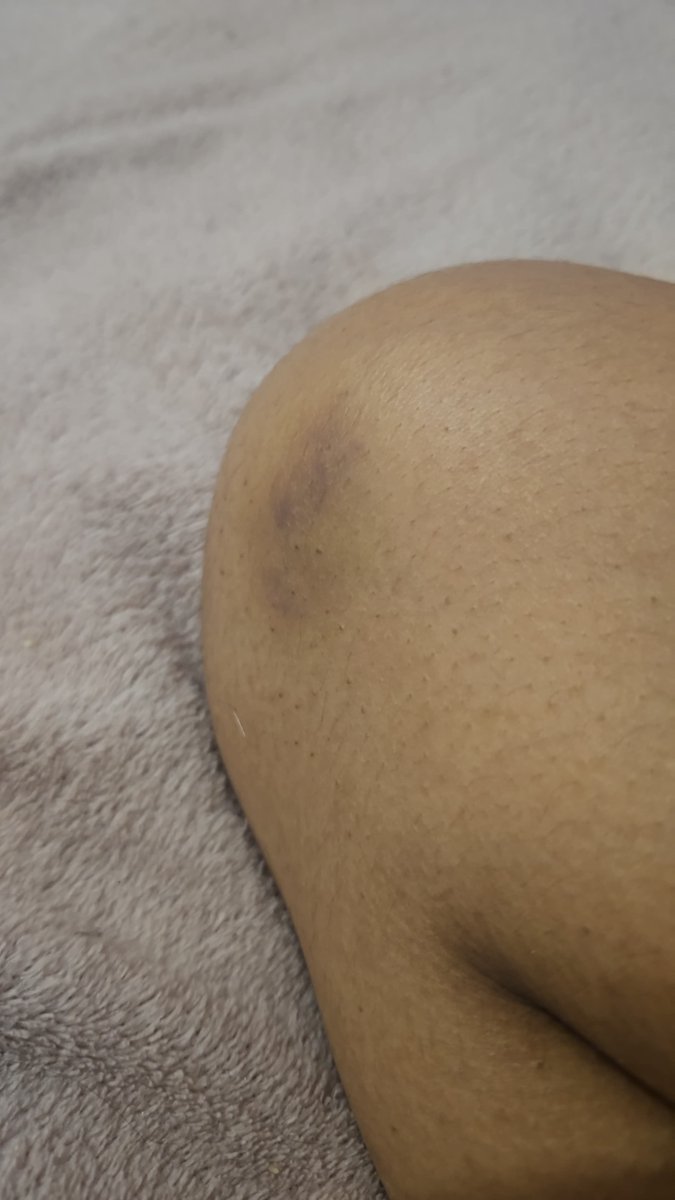 leesn0w_'s tweet photo. @exercitooficial abaixo algumas das fts que registrei dos hematomas após as agressões que ocorreram no dia. https://t.co/B3WDJdvYY7