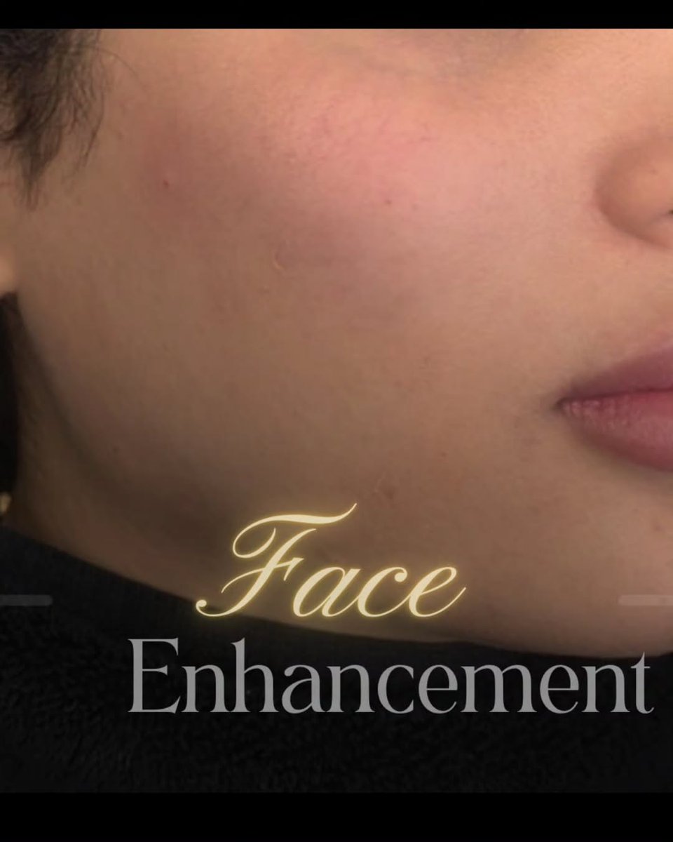 dr_laracheajfuc's tweet photo. Natural face enhancement to make the face look rounder. https://t.co/iyk7i4C8NQ