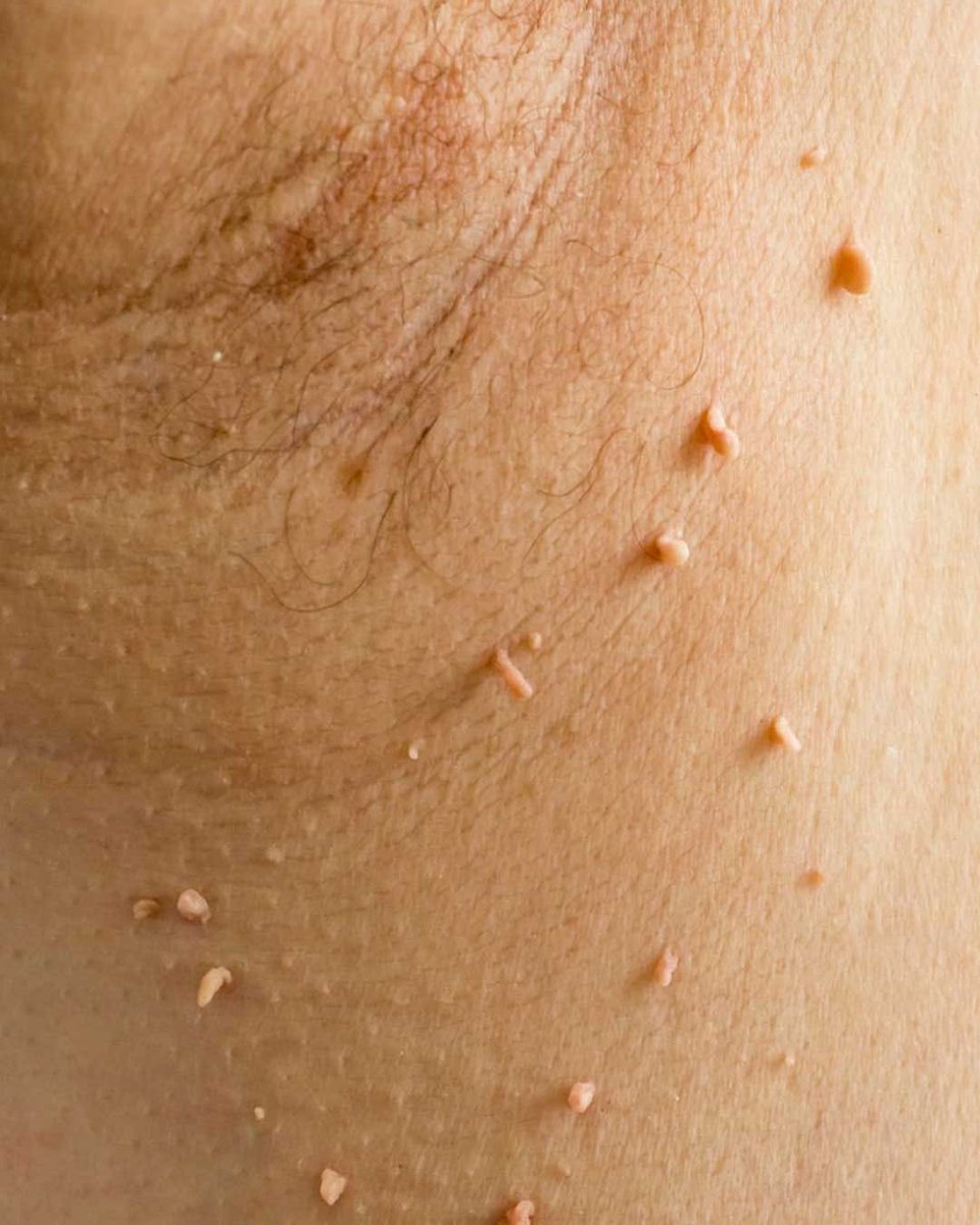 Josimardias111's tweet photo. Mystery armpit spots on my brother  any ideas what these are? https://t.co/YT0whEejGH