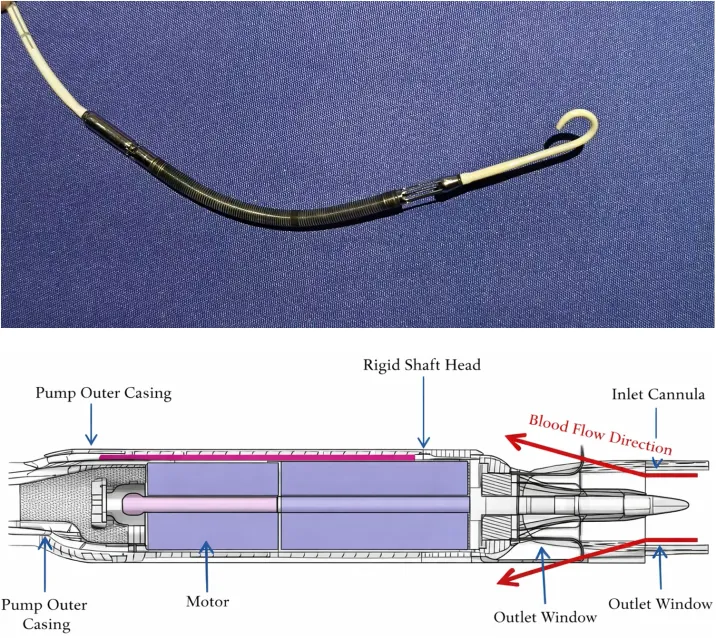 gbiondizoccai's tweet photo. Welcome to an intriguing observational study, courtesy of Catheterization & Cardiovascular Interventions, apprasiging the efficacy and safety of the CorVad System (Shenzhen Core Medical Technology Co) for PCI in 118 CHIPs https://t.co/tZt75Is5MI #CorVad @ccijournal https://t.co/4fI57lF3ak