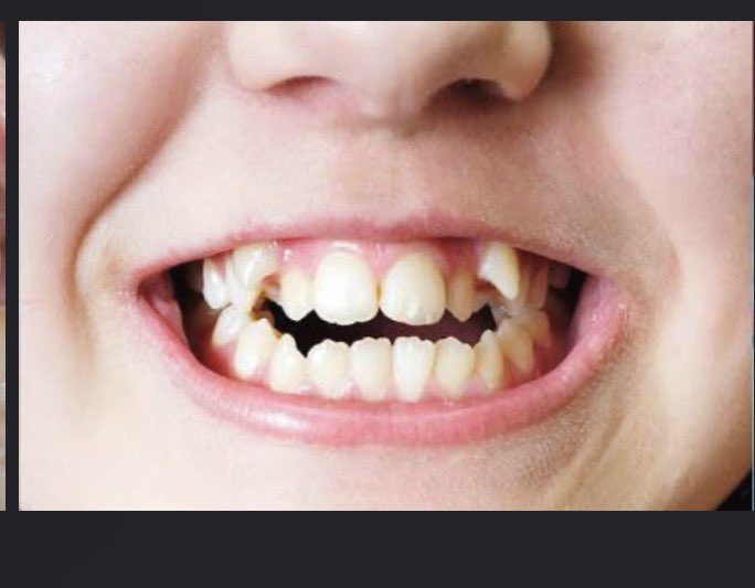 chidustarrrrrr_'s tweet photo. This is how Belema supernumerary teeth looks like 
I still wonder how he’s bottoming for his homeboys and still having sexual relationships W the fugliest bottoms. https://t.co/Y5VoMklJM2