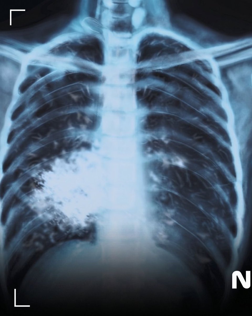 NeuralSpace_'s tweet photo. 🫁🚬⚠️ INFO || Le vapotage a été formellement lié à un maladie pulmonaire rare: la bronchiolite oblitérante (ou « poumon popcorn »), irréversible et invalidante. 

Selon un rapport médical relayé par The Conversation. https://t.co/AISX1KK3Fs
